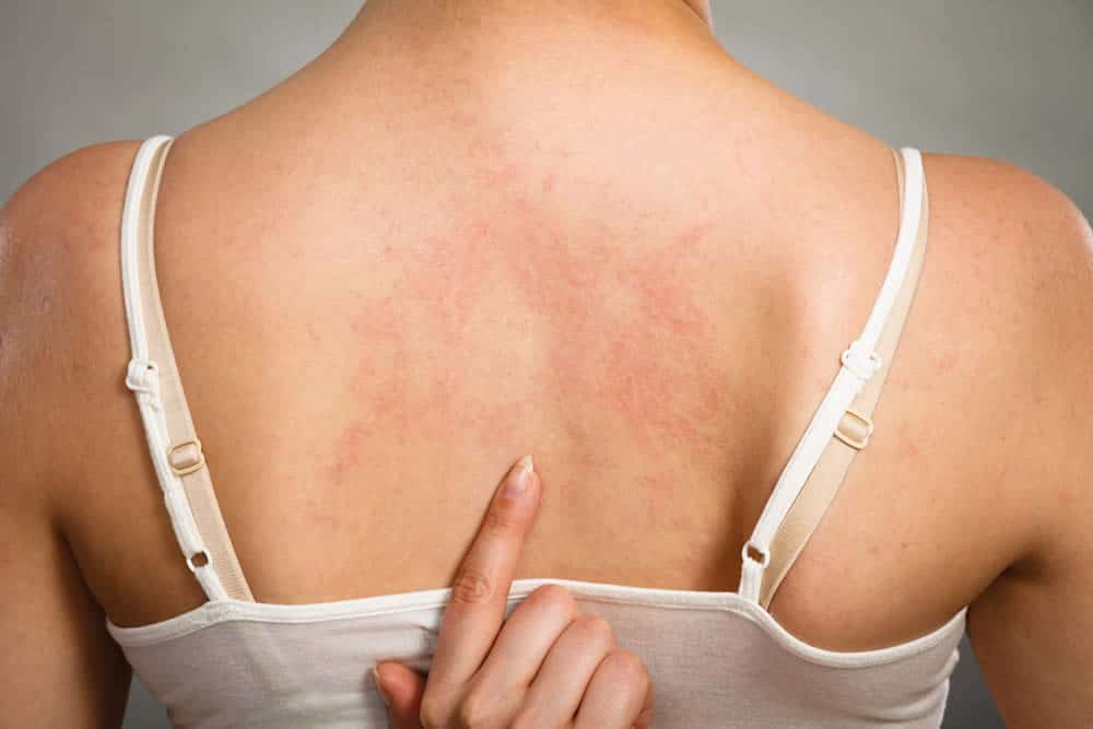 Chemotherapy Plus Involved Field Radiation in Early Stage Hodgkin’s Disease